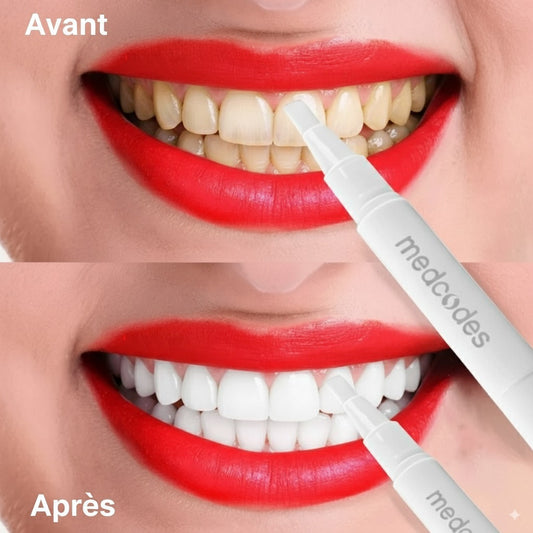 Stylo Gel de Blanchiment Dentaire – Retrouver un sourire éclatant en quelques jours